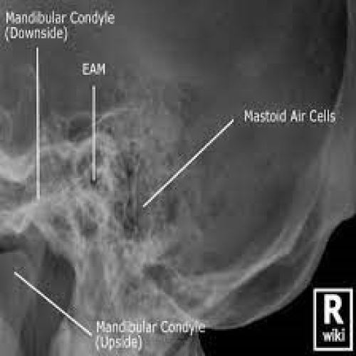Xray Of Mastoid Bone Test 1S Pharma